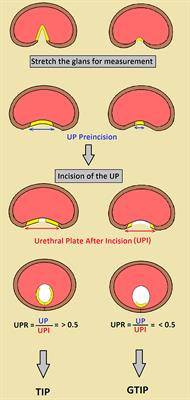When to Graft the Incised Plate During TIP Repair? A Suggested Algorithm That may Help in the Decision-Making Process